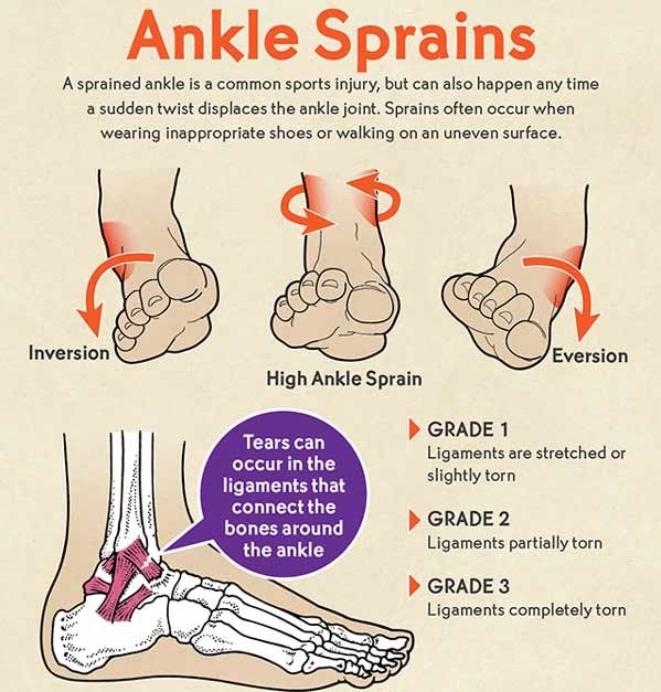 ankle-sprain-physio-pooja