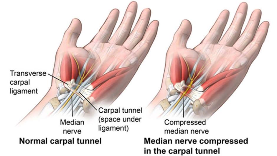 How Does Carpal Tunnel Syndrome Disrupt Homeostasis