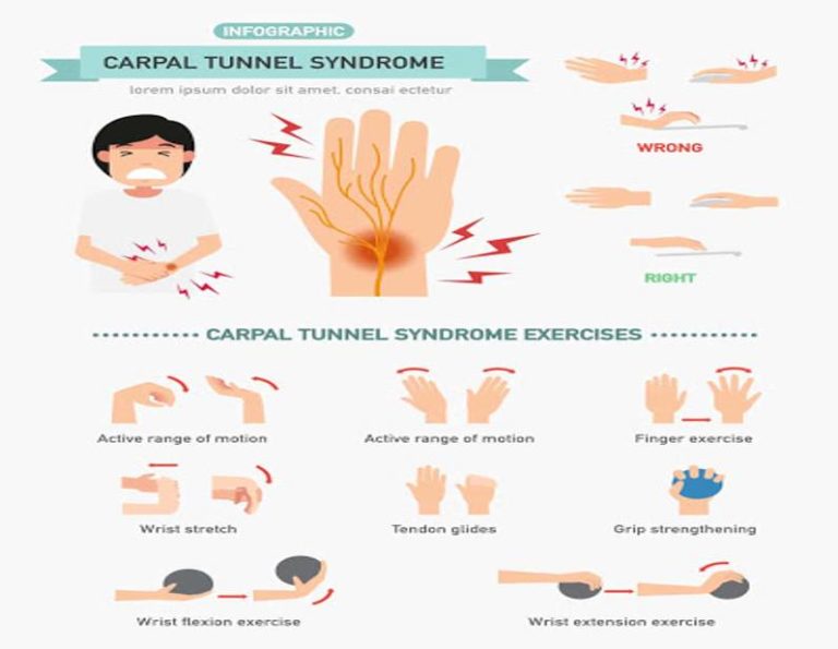 Carpal Tunnel Syndrome - Physio Pooja