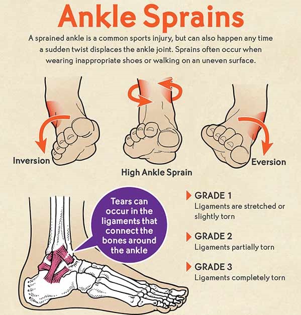 Sprains: Types, Symptoms & Treatment