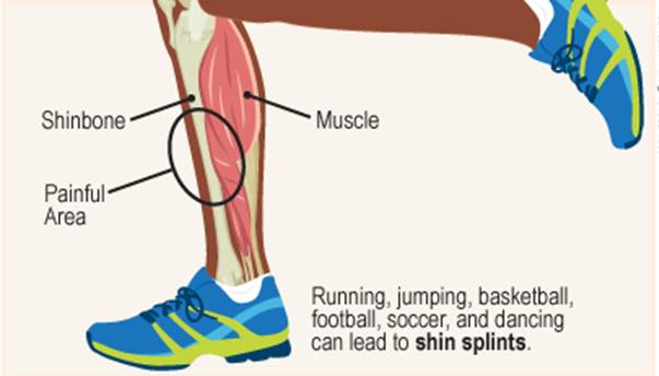shin-splint-syndrome2