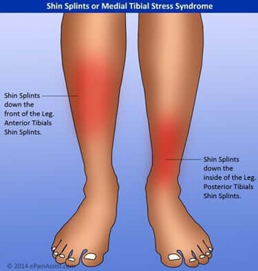 shin-splint-syndrome4