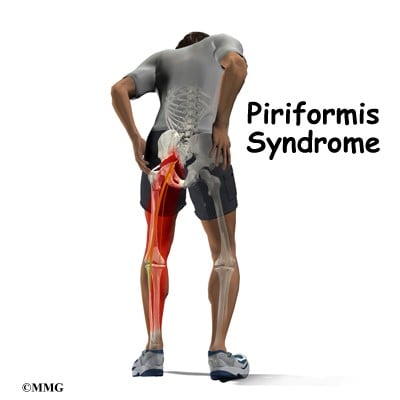 Piriformis Syndrome - Physio Pooja